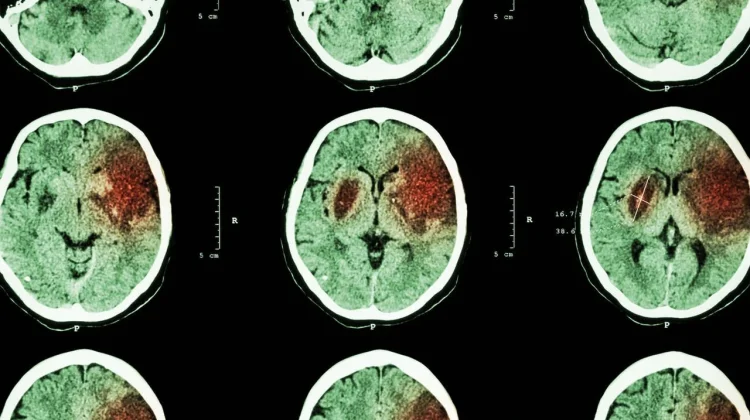 Indonesian Govt to Intensify End-To-End Prevention to Reduce Stroke Cases