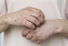 Indonesia Responds to Measles Case Involves Travel from Indonesia to Australia