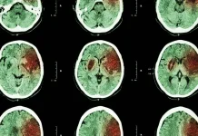 Indonesian Govt to Intensify End-To-End Prevention to Reduce Stroke Cases