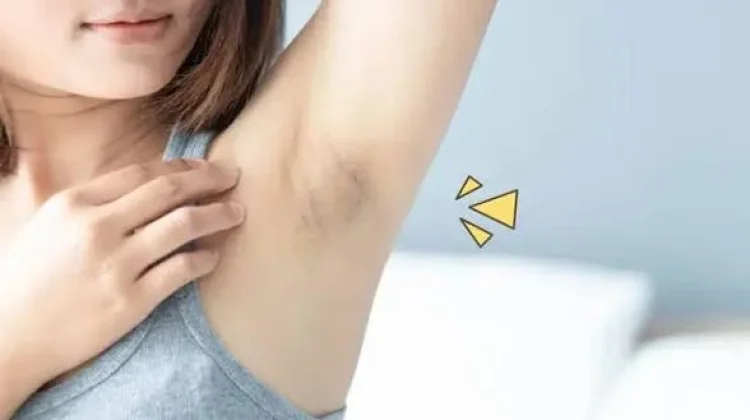 Mencukur atau Mencabut Bulu Ketiak? Kenali Manfaat dan Risikonya
