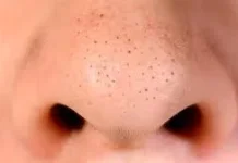 Tips Menghilangkan Komedo agar Wajah Tetap Bersih