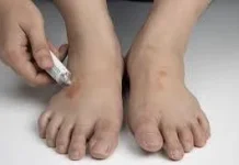 Cara Menghilangkan Kurap Secara Tepat dan Aman