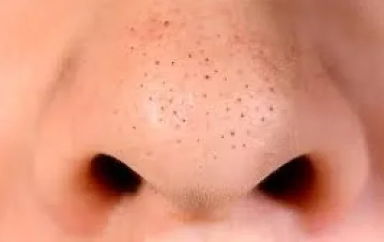 Tips Menghilangkan Komedo agar Wajah Tetap Bersih