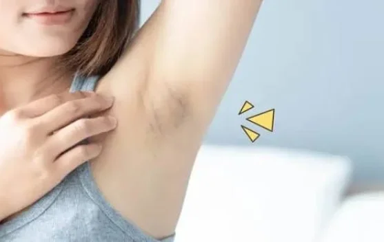 Mencukur atau Mencabut Bulu Ketiak? Kenali Manfaat dan Risikonya