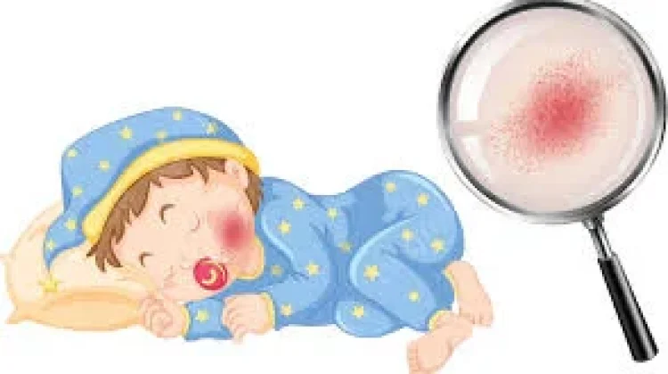 Puskesmas Way Tuba: Belum Ada Kasus Campak di Wilayah Kerja