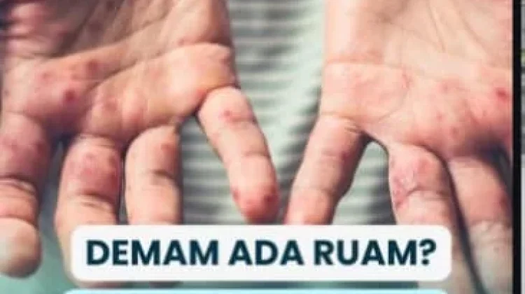Demam Ada Ruam ? Jangan Malah Keluyuran