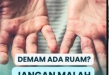 Demam Ada Ruam ? Jangan Malah Keluyuran