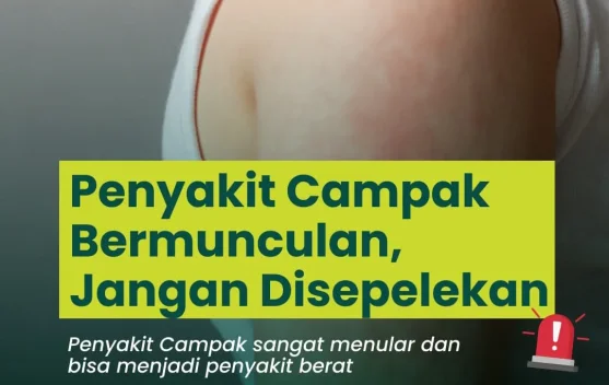 Penyakit Campak Bermunculan Jangan Disepelekan