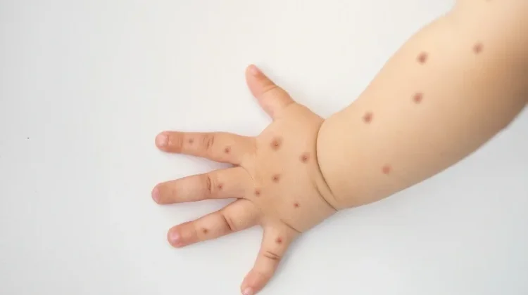 Kenali Tanda Flu Singapura pada Anak
