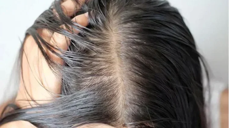 Rambut Lepek dan Berminyak, Kenali Penyebabnya sejak Dini