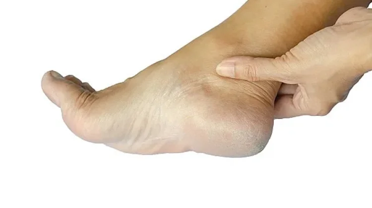 Tips Atasi Kaki Pecah-Pecah