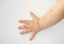 Kenali Tanda Flu Singapura pada Anak